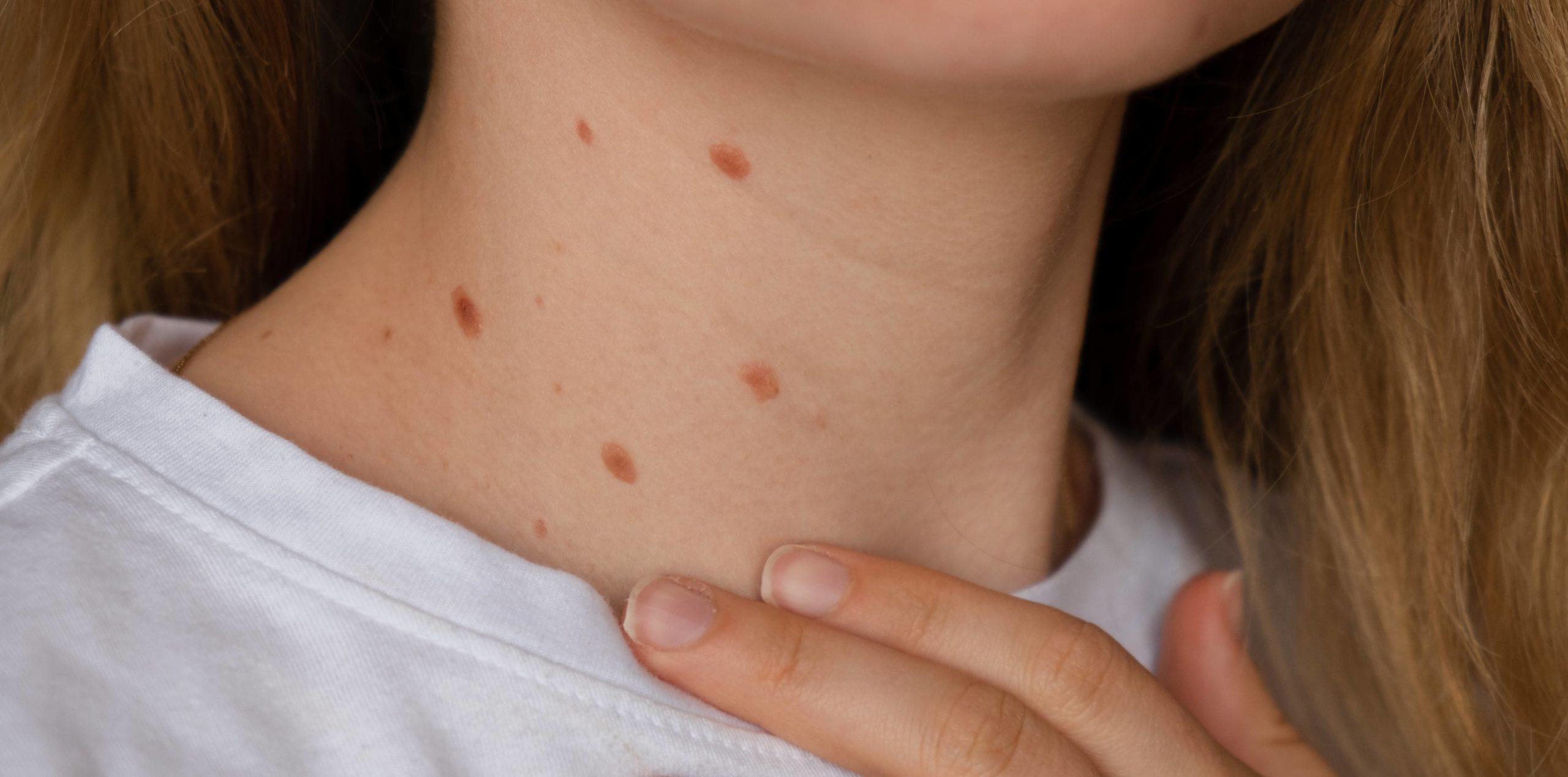 Siğil Nedir? Genital Siğil Nedir? HPV Siğil Tedavisi Hakkında Merak Edilenler