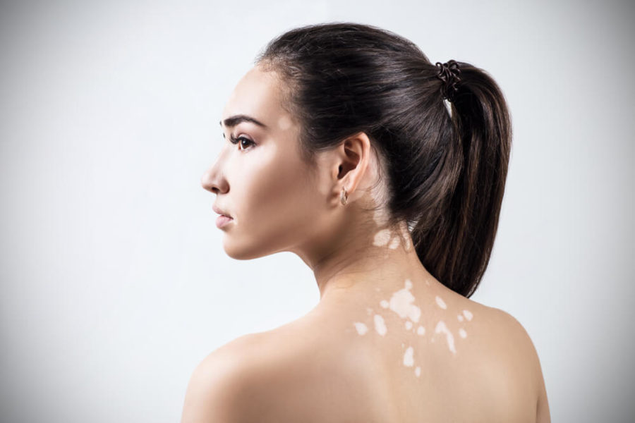 Vitiligo Nedir? Vitiligo Belirtileri ve Tedavi Yöntemleri Nelerdir?