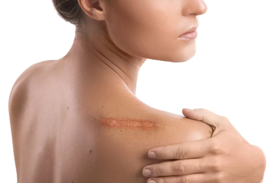 Keloid Nedir? Keloid Belirtileri Nelerdir?